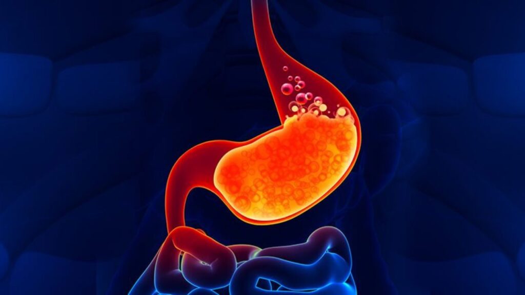 Acid-Reflux-Disease-1280x720