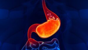 Acid-Reflux-Disease-1280x720