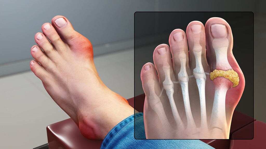 1280px-Gout_Signs_and_Symptoms