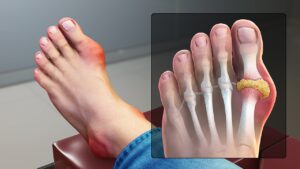 1280px-Gout_Signs_and_Symptoms