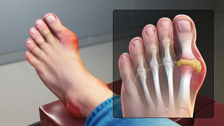 1280px-Gout_Signs_and_Symptoms