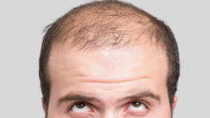 male-pattern-baldness-1280x720
