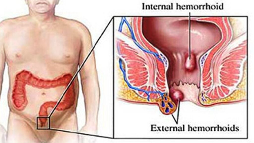 piles-treatment-bengaluru-top-doctors-1280x720