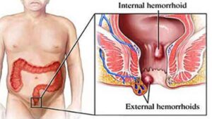 piles-treatment-bengaluru-top-doctors-1280x720