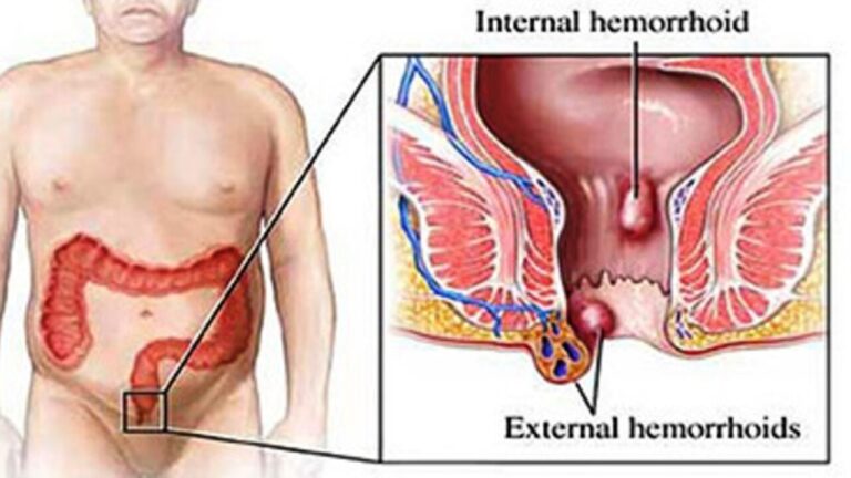 piles-treatment-bengaluru-top-doctors-1280x720