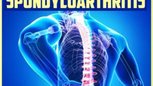 Axial-spondyloarthritis-cover-1280x720