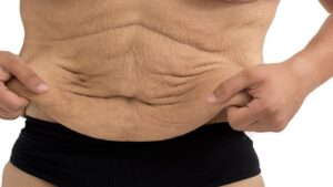 excess skin