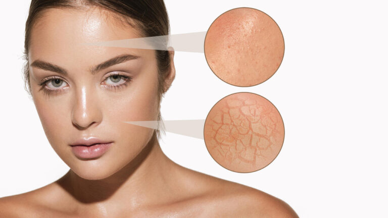 Female skin problems close-up. Beautiful brunette woman and facial diseases: acne, blackheads, dry, oily, wrinkles. White background. Skincare, healthcare, beauty, health, aging process