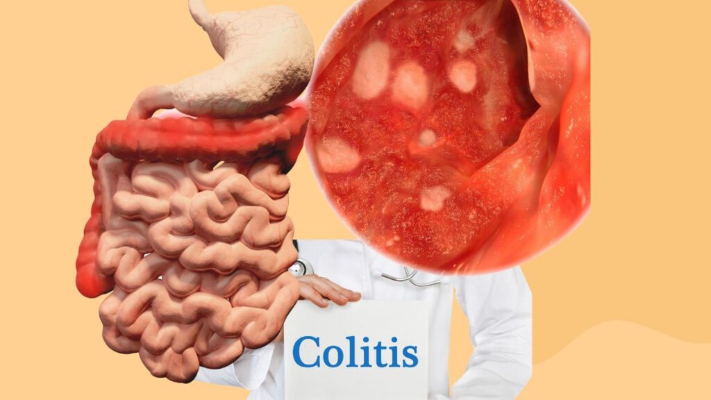 Understanding-Colitis-Symptoms-and-Treatment
