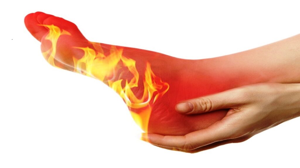 burning_feet