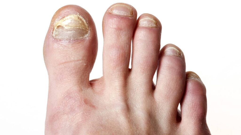 fungal-nail-infections-image-2
