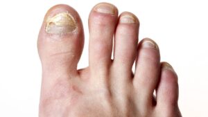 fungal-nail-infections-image-2