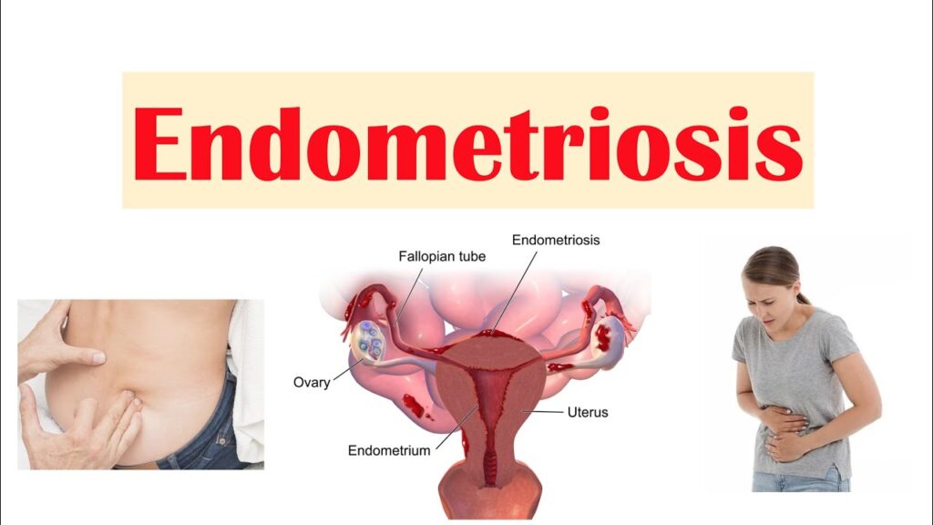 endometriosis