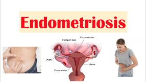 endometriosis
