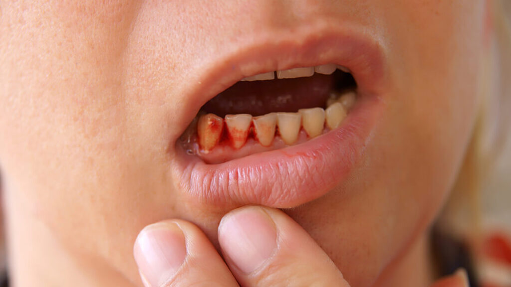 gum bleeding