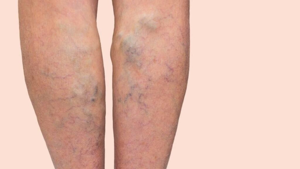 varicose veins