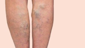 varicose veins