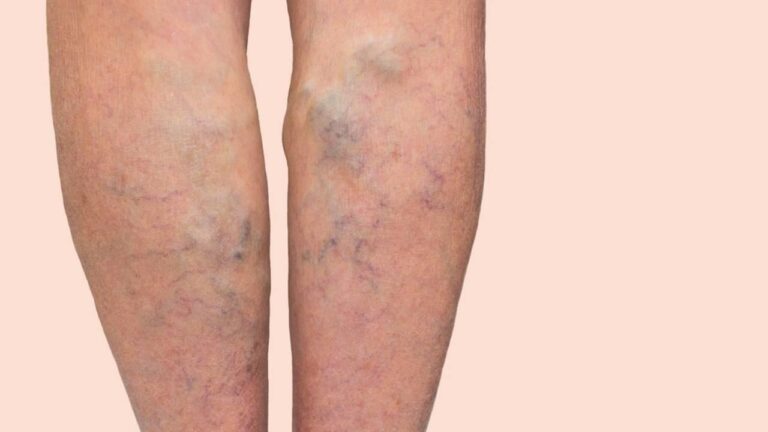 varicose veins