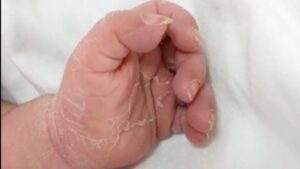 skin peeling