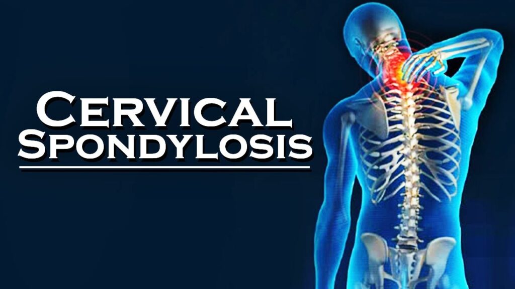 cervical-spondylitis