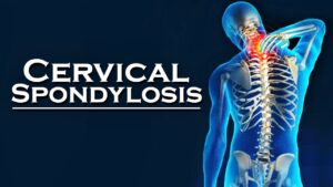 cervical-spondylitis