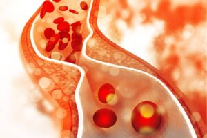 homeopathy-for-cholesterol