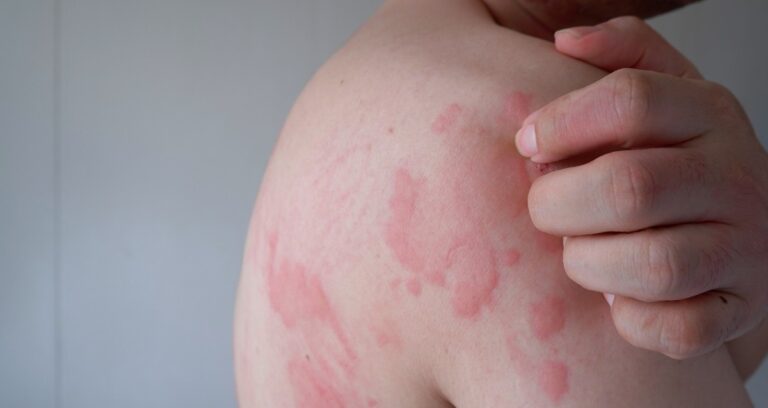 urgent-care-for-hives-patients