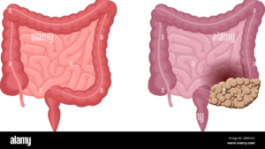bowel