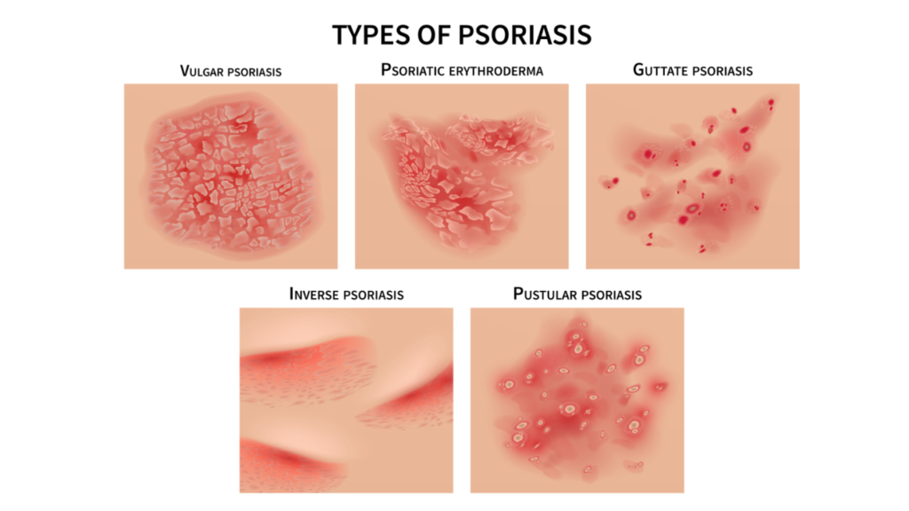 psoriasis