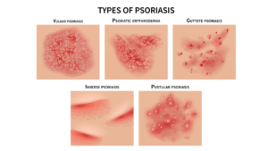 psoriasis