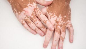 12419-vitiligo